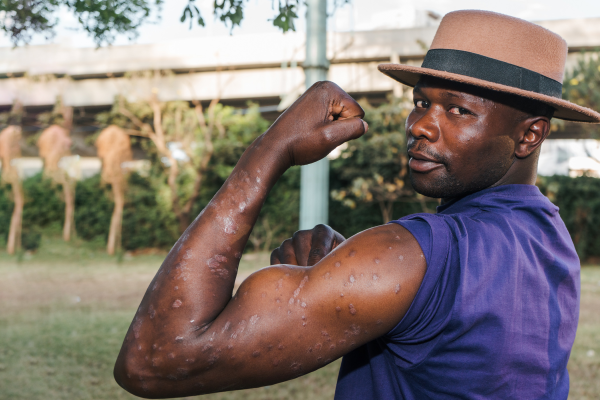 Man with psoriasis on World Psoriasis Day 2022